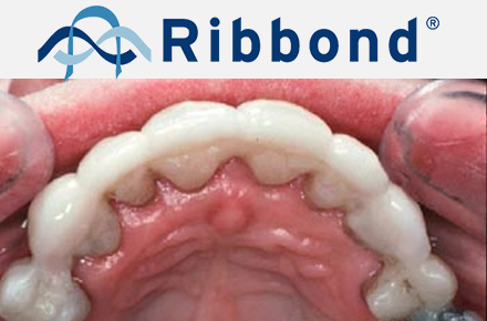 Шины Ribbond на верхней челюсти Шины Ribbond на верхней челюсти