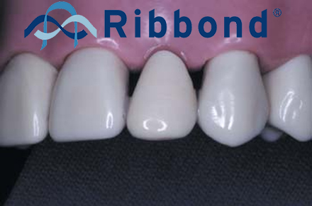 Мост из Ribbond в одно посещение