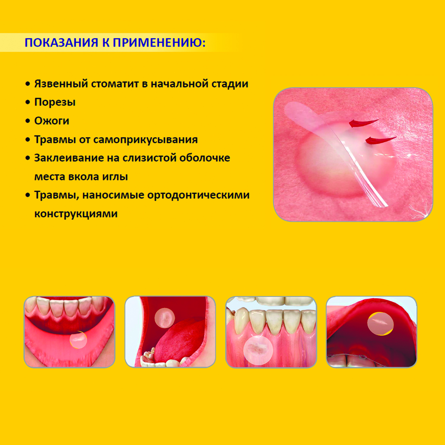 НАБОР: Заживляющий пластырь для слизистой рта CURATICK, 2шт/ упак. - 4шт/2упак.