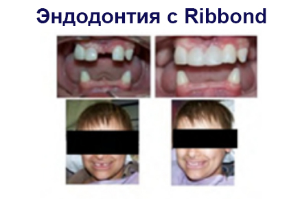 Эктодермальная дисплазия Эктодермальная дисплазия