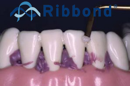 Шинирование патологически подвижных зубов