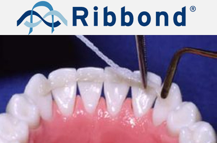 Ортодонтический ретейнер Ribbond и закрытие диастемы