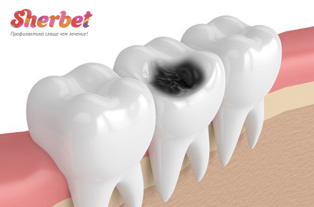 Влияние на зубной кариес местного применения кислого фосфат-фторида