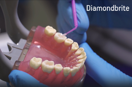 Реставрация полости I класса наногибридным композитом Diamondbrite Реставрация полости I класса наногибридным композитом Diamondbrite