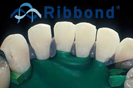 Пародонтальное шинирование с помощью Ribbond THM Пародонтальное шинирование с помощью Ribbond THM